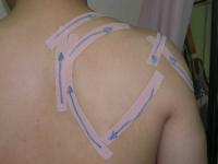肩甲骨運動障害時のヒーリングテープ